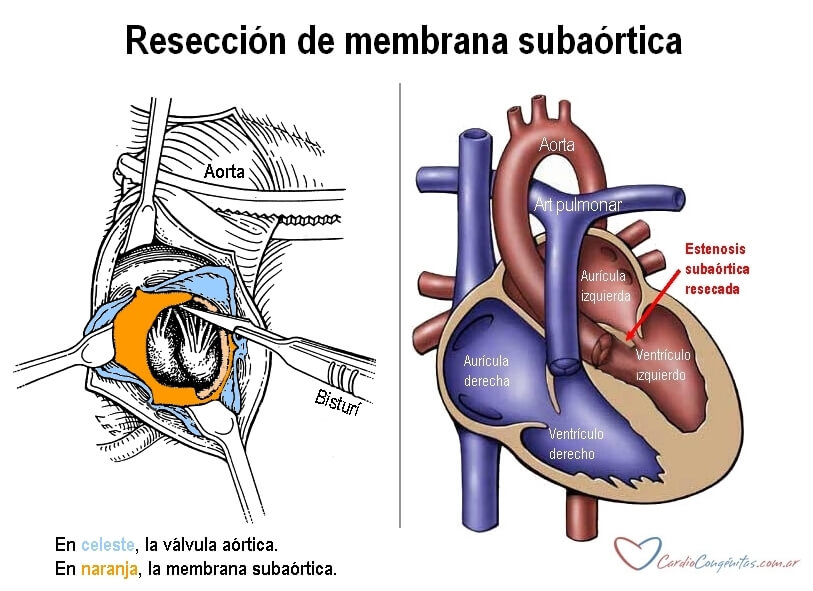 Reseccion-de-membr-subao