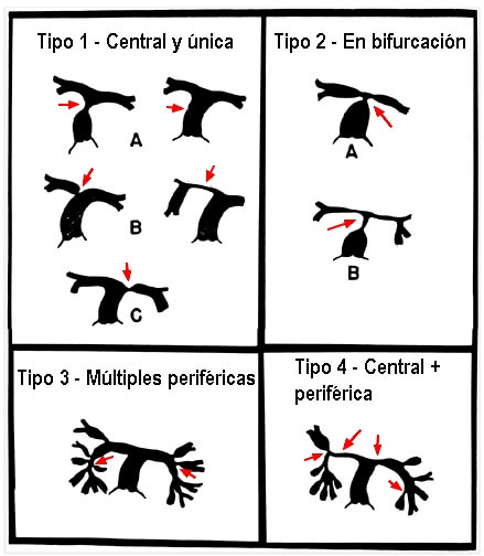 Clasificacion-estenosis-de-ramas