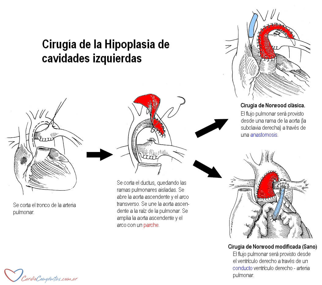 Cirugia-hipoplasia