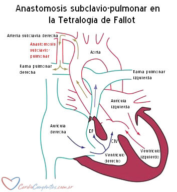 ASPD
