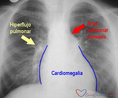 Rx-IC-sin-cianosis