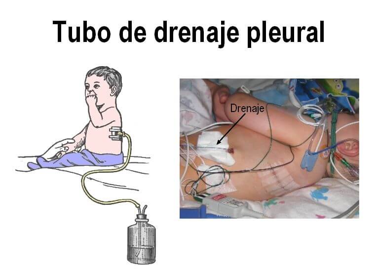 Drenaje-pleural