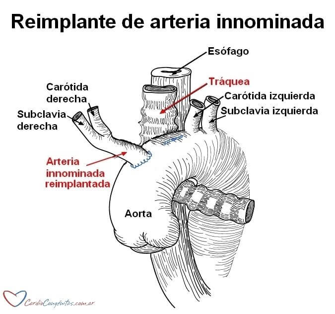 compresion-por-innominada-cirugia