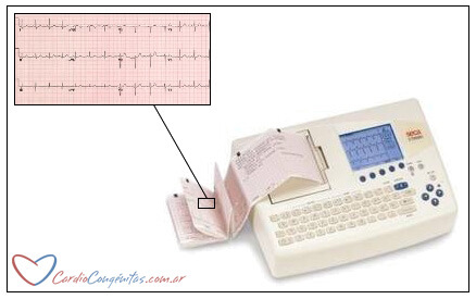 ECG