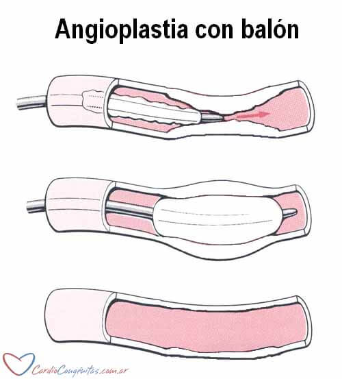 Angioplastia-con-balon