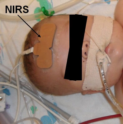 NIRS