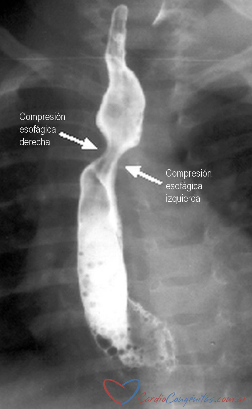 Esofagograma