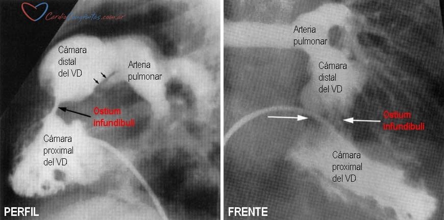 Hemodinamia-doble-camara