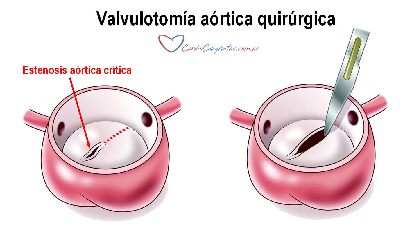 Valvulotomia-qca