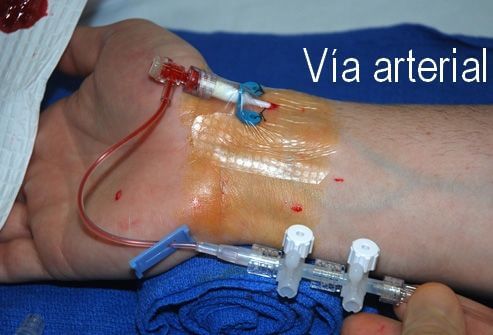 Via-arterial