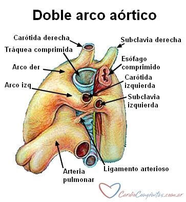 Doble-arco-aortico