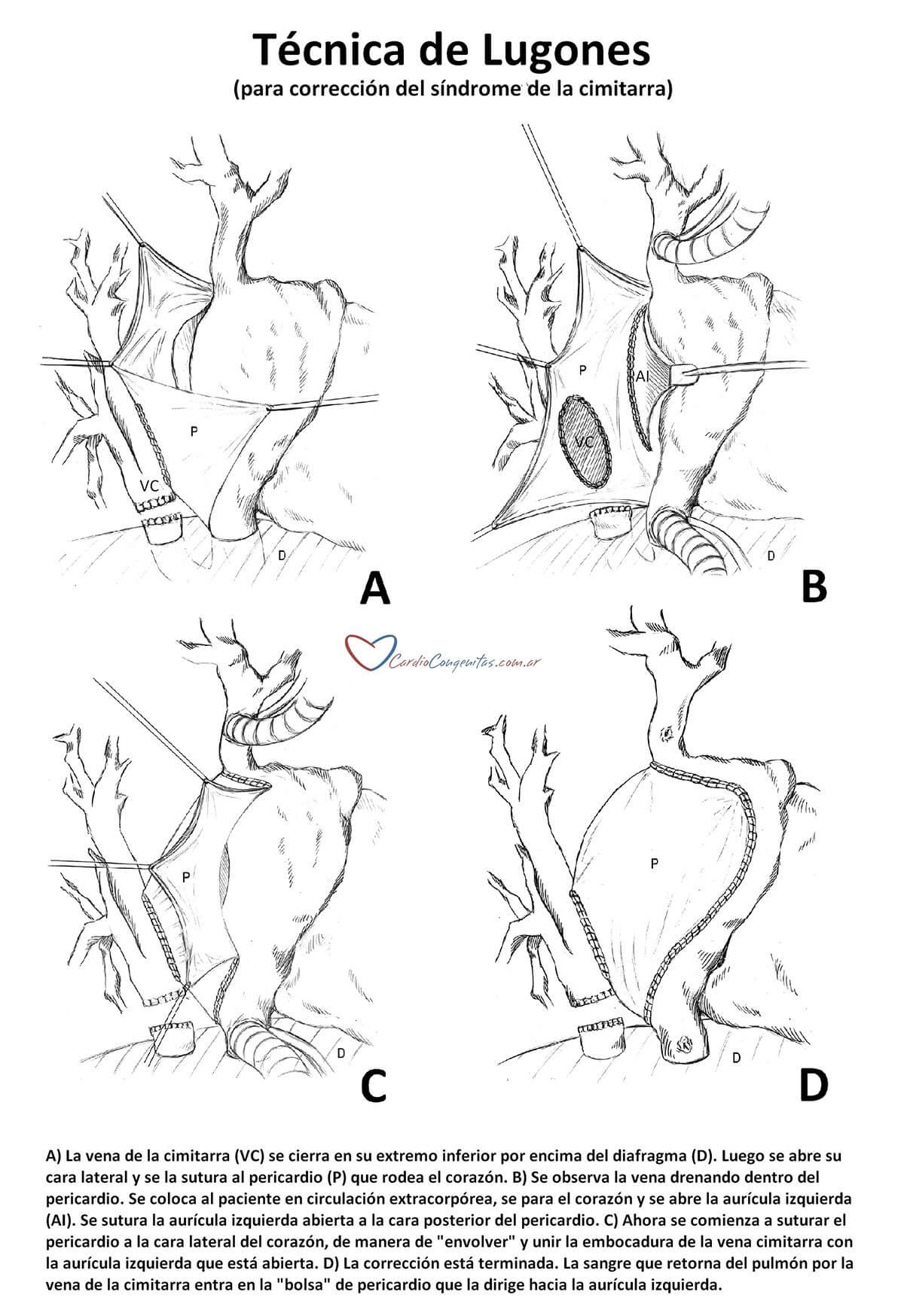 Cimitarra-tecnica-Lugones-para-cardiocongenitas