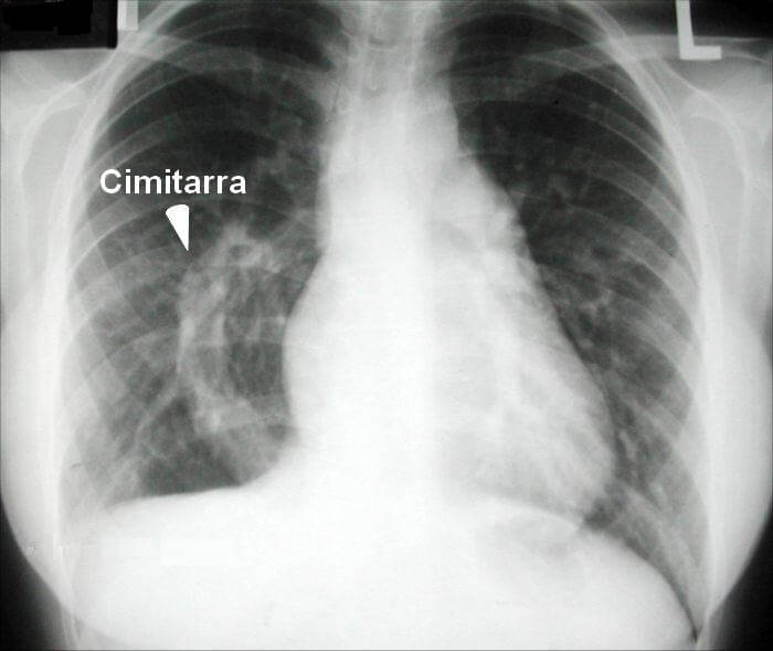 Rx-torax-tipica
