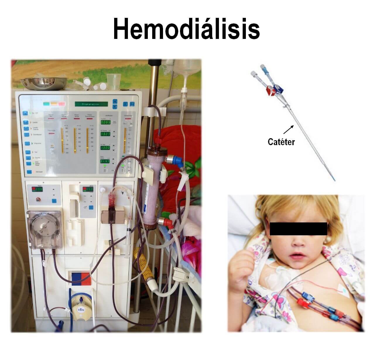 Hemodialisis