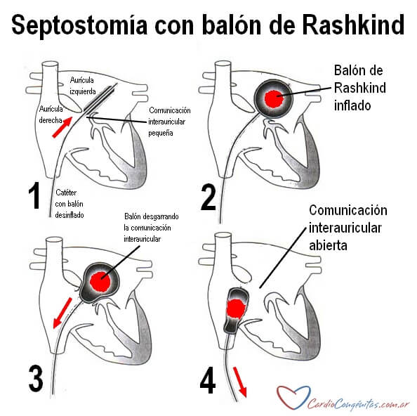 Rashkind