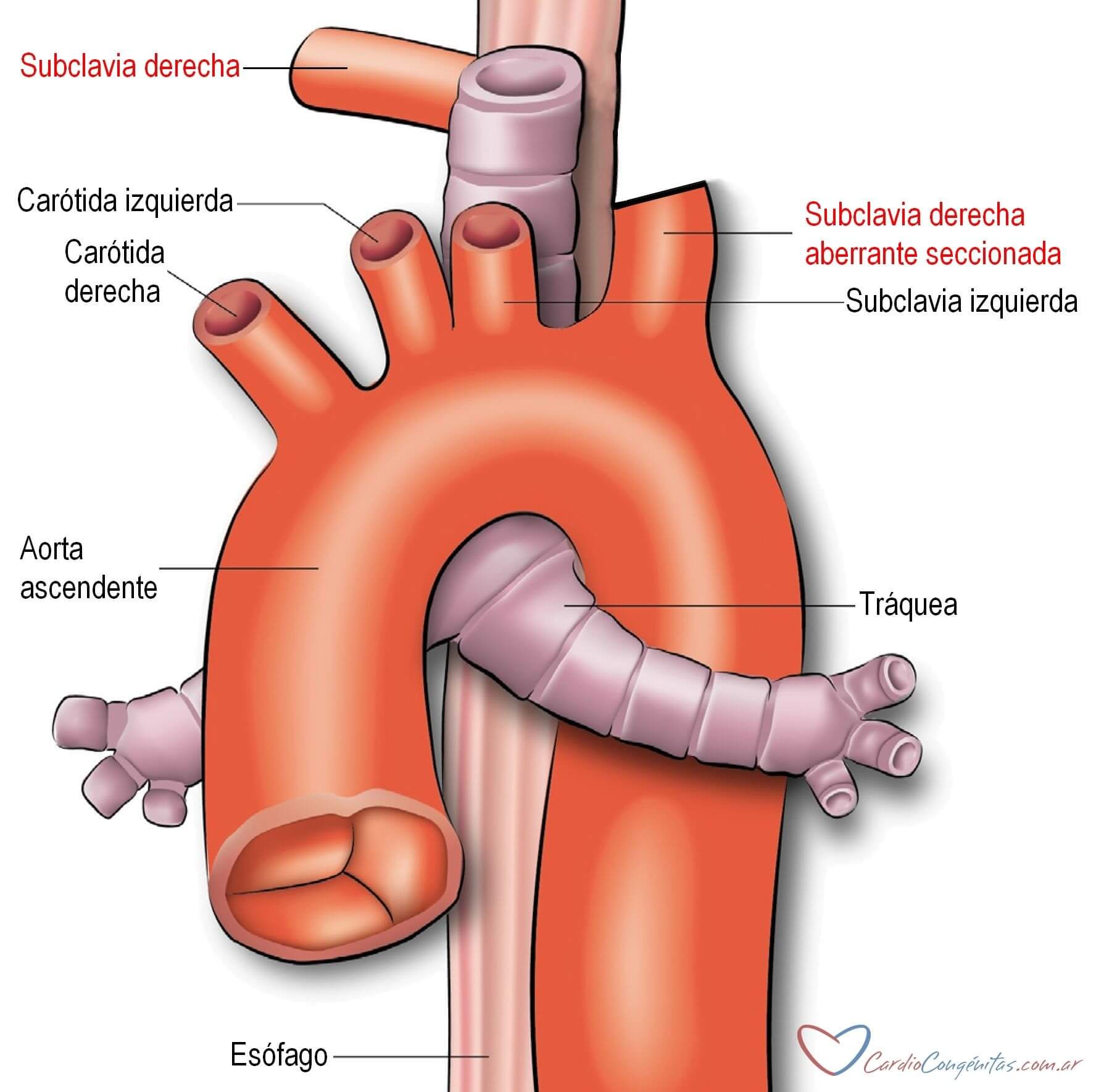 subclavia-der-aberr-cirugia