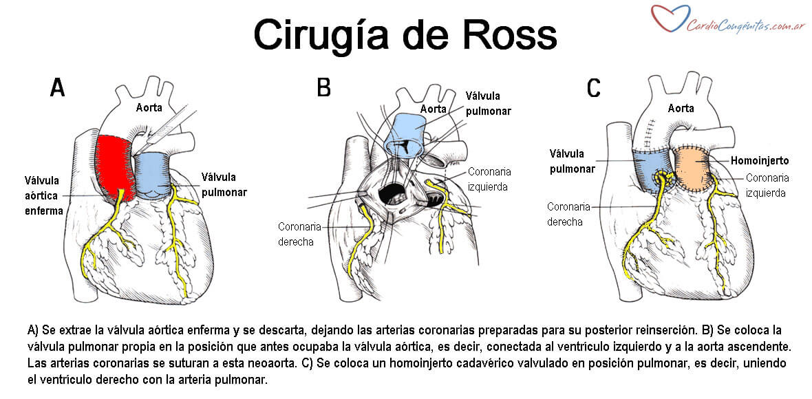 Ross