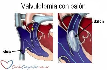 Valvulotomia-con-balon