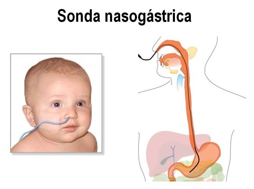 Sonda-nasogastrica