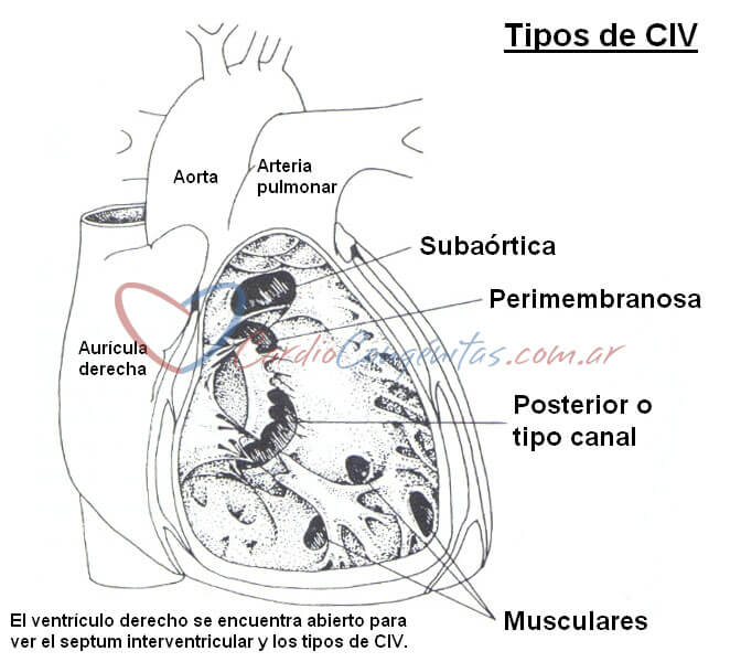CIVs-tipos