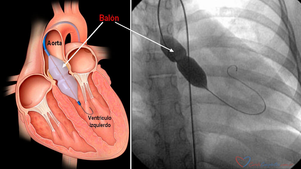 Angioplastia-con-balon