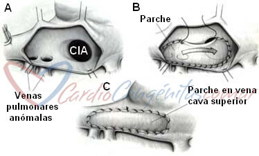 Cirugia-APRVP