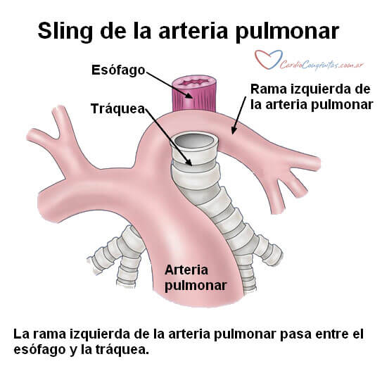 sling-de-la-pulmonar