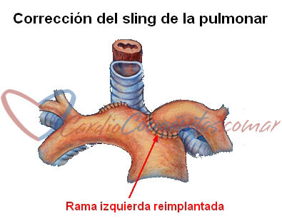 sling-correccion