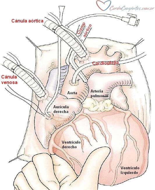 Canulacion
