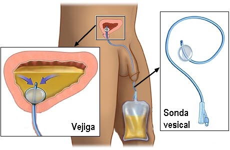 Sonda-vesical