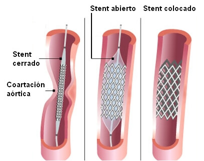 Stent