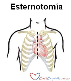 Esternotomia